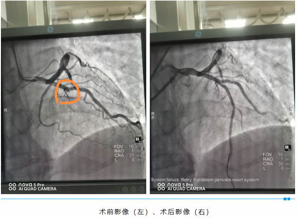與死神賽跑，爲生命接力——我院成功 搶救一名急性心肌梗死患者